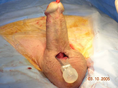 Penis Pump Implant 24