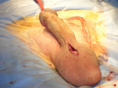 Penile Implant Surgery Figure 11