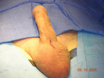 Penile Implant Surgery Figure 12