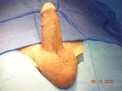 Penile Implant Surgery Figure 13