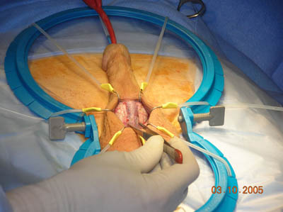 Penile Implant Surgery Figure 3