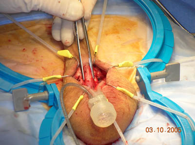 Penile Implant Surgery Figure 7