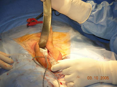 Penile Implant Surgery Figure 8