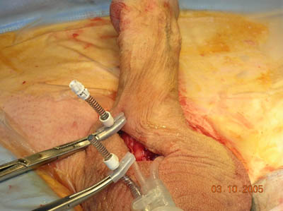 Penile Implant Surgery Figure 9